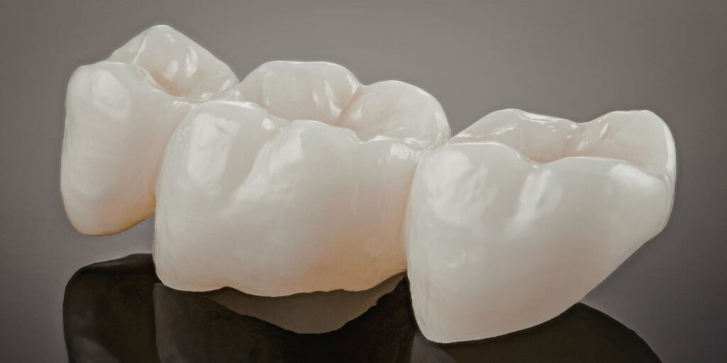 What is a dental bridge?