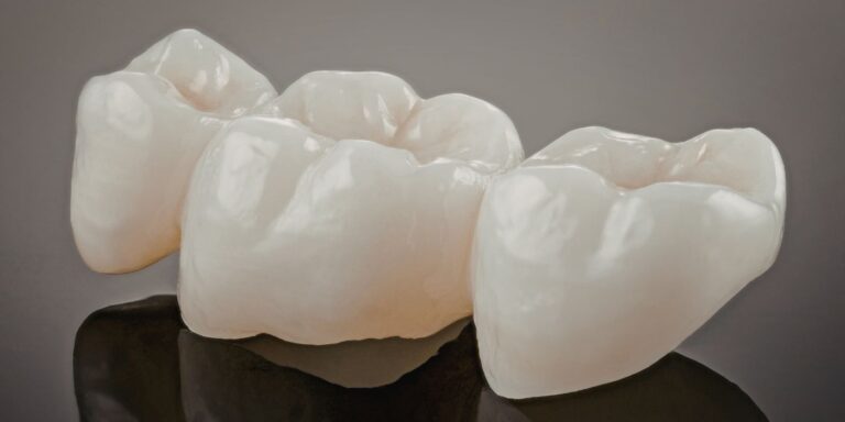 What is a dental bridge?