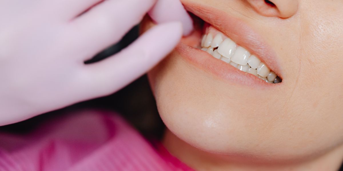Wisdom tooth extraction