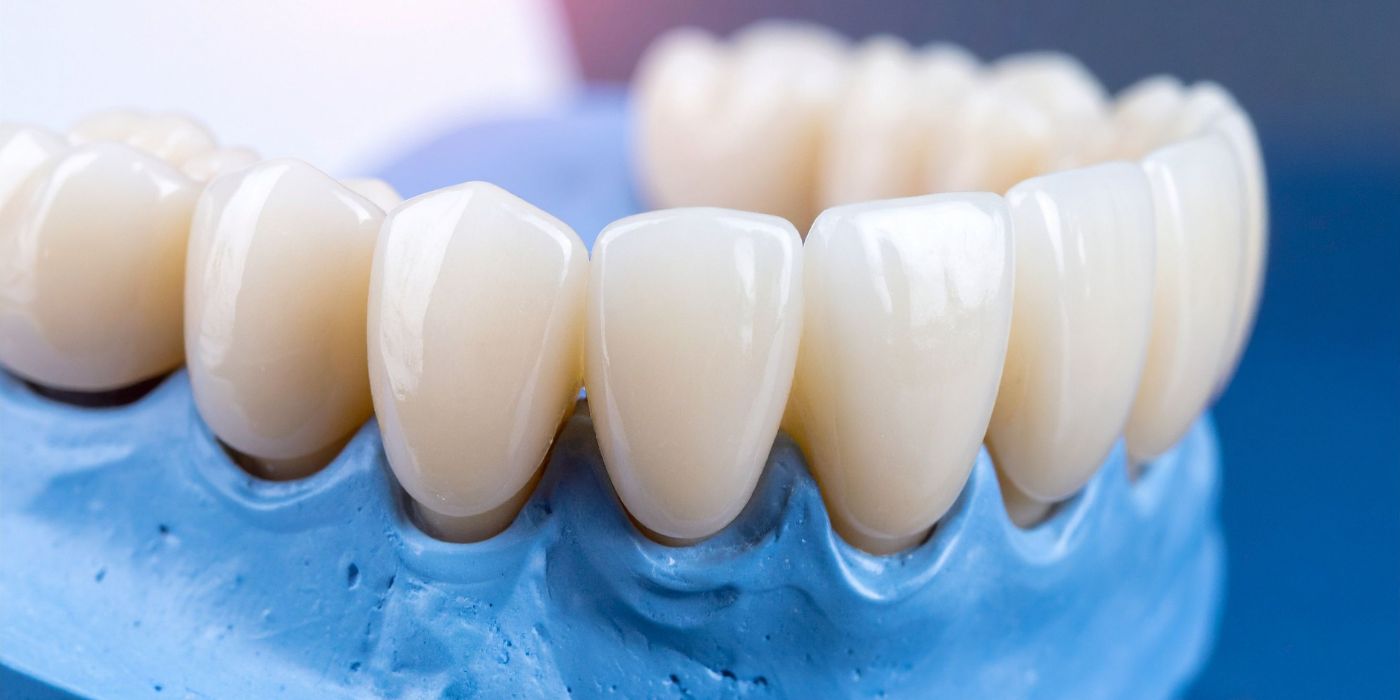 What is a dental bridge?
