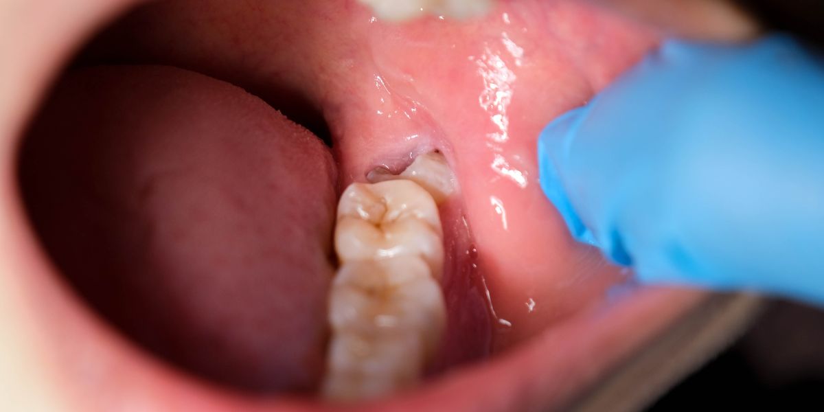 Wisdom tooth extraction