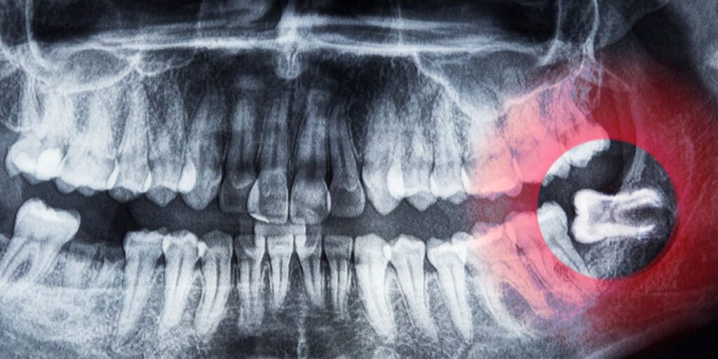 Wisdom tooth extraction